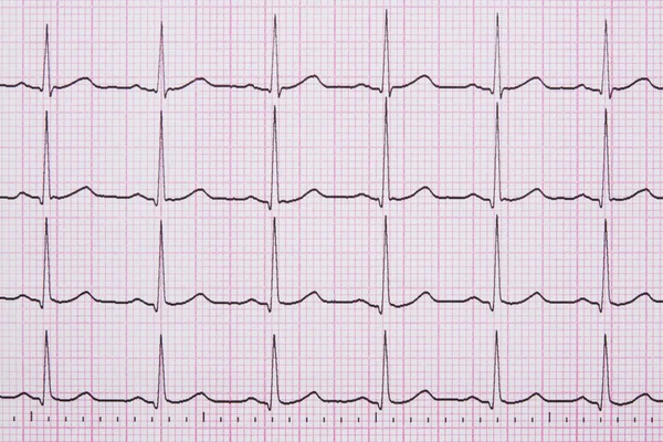 Primo piano di un elettrocardiografo noto anche come elettrocardiografo — Foto Stock