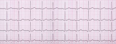 Bir Electrocardiograph olarak da bilinen bir Ekg kapatın