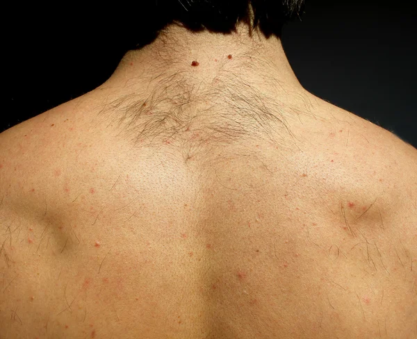 A man from hairs on the back — Stock Photo, Image