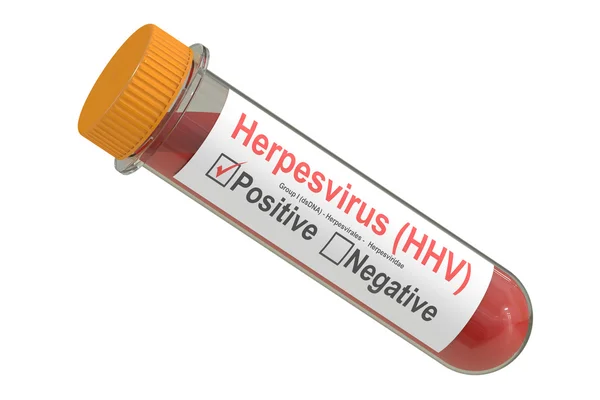 긍정적인 herpesvirus hhv 바이러스 혈액 샘플 테스트 튜브, — 스톡 사진