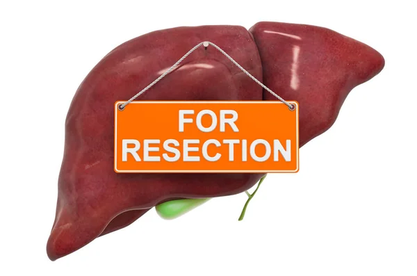 Concept Résection Foie Foie Humain Avec Panneau Suspendu Resection Rendu — Photo