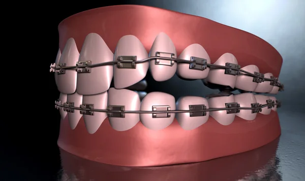 Жуткие зубы с брекетами — стоковое фото