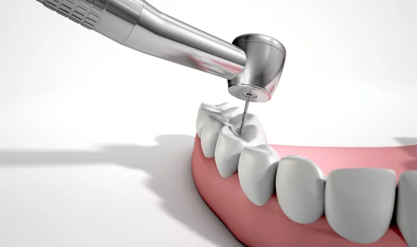 Dentistas taladro y dientes — Foto de Stock