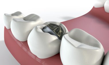 Teeth With Lead Filling clipart