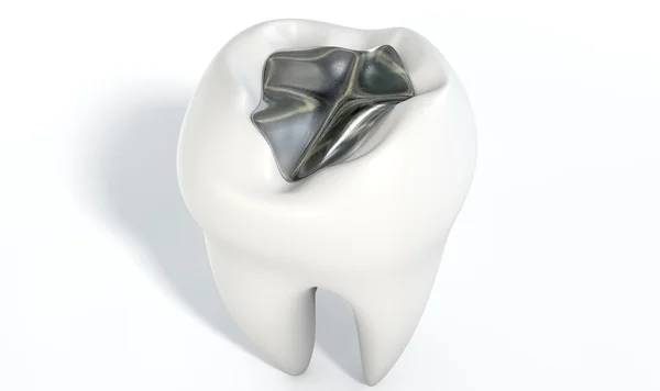 Tooth With Lead Filling — Stock Photo, Image