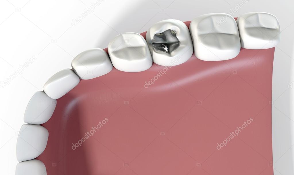 Teeth With Lead Filling