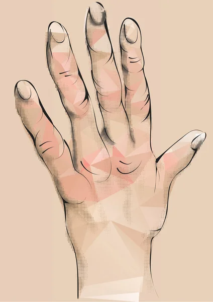 Αρθρίτιδα. χέρι με παραμορφωμένα δάχτυλα — Διανυσματικό Αρχείο