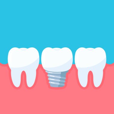 Diş implantı ve sakızdaki dişler. Diş implantı sembollü diş kliniği taşıyıcı illüstrasyon EPS 10