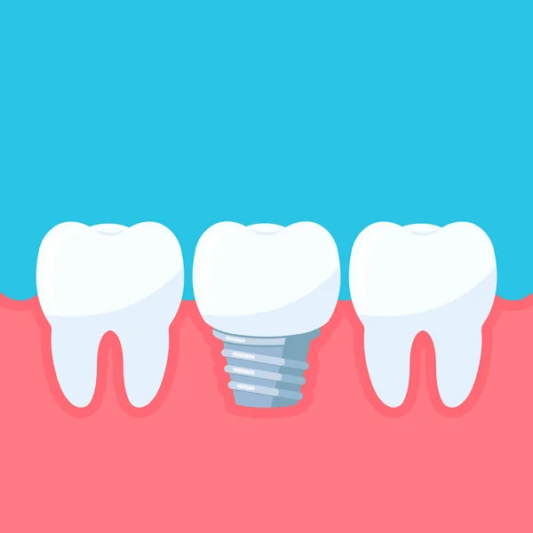Implants Dentaires Dents Dans Gencive Dent Avec Implant Symbole Clinique — Image vectorielle