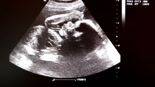 Vídeo del monitor con ultrasonido de un bebé a las 21 semanas — Vídeo de stock