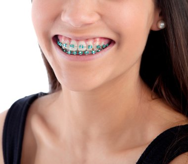 Smiling teenager girl with brackets clipart