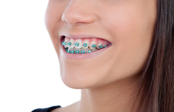 Attractive young woman with brackets — Stock Photo, Image