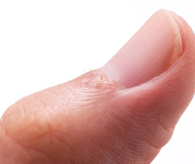 A close-up of a man's finger hangnail on a white background clipart
