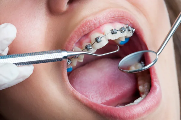 Extreme close up of human mouth with braces. — Stock Photo, Image