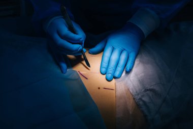 Cerrahın elinin yakın fotoğrafını çek neşteri tut ve cerrahi lambanın ışığı altında hastanın derisini kes. Tıbbi konsept.