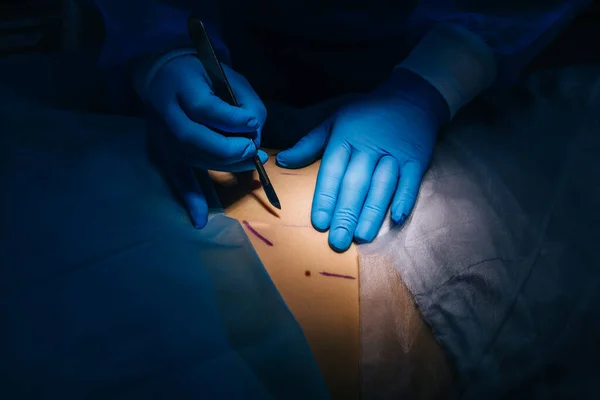 Feche Foto Mão Cirurgião Segure Bisturi Faça Uma Incisão Pele — Fotografia de Stock