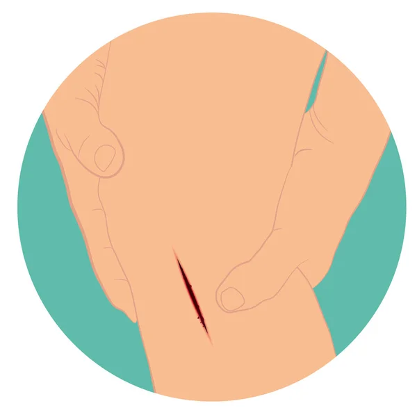 Bacağında Kanamalı Kesik Bacak Vektörü Çiziminde Yara Var — Stok Vektör