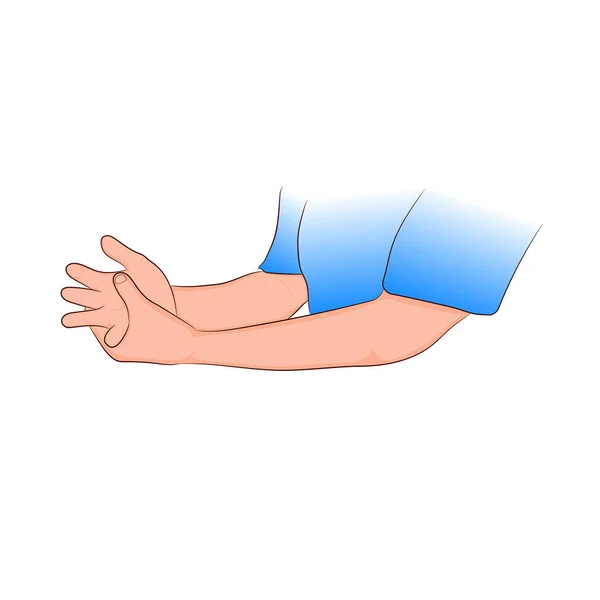 Guillain Barre Syndrom Schmerzen Handgelenk Werden Häufig Verursacht Oder Steigen — Stockvektor