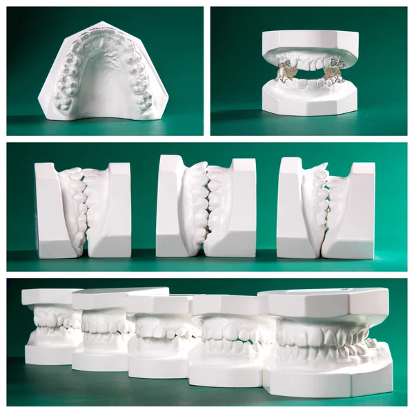 Compilation picture of dental study models — Stock Photo, Image