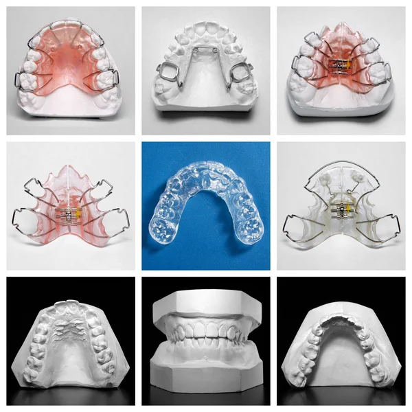 Essix-リテーナ歯列矯正と研究モデルに囲まれて — ストック写真