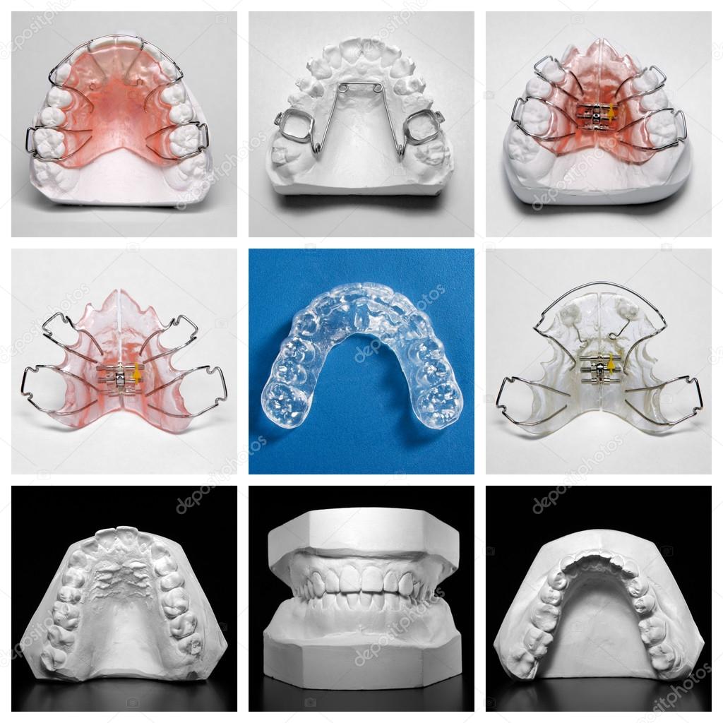 Essix retainer surrounded by orthodontic appliances and study models