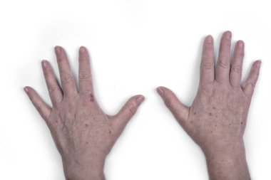 Yaralı ve lekeli yaşlı kadın elleri