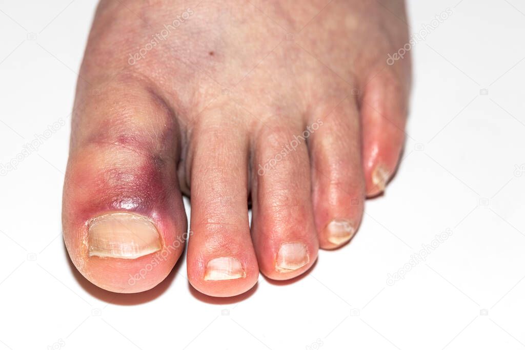 Close up view of damaged foot with bruise big toe. Injuries concept.