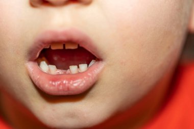 İlk dişini kaybetmiş çocuğun ağzını kapat..