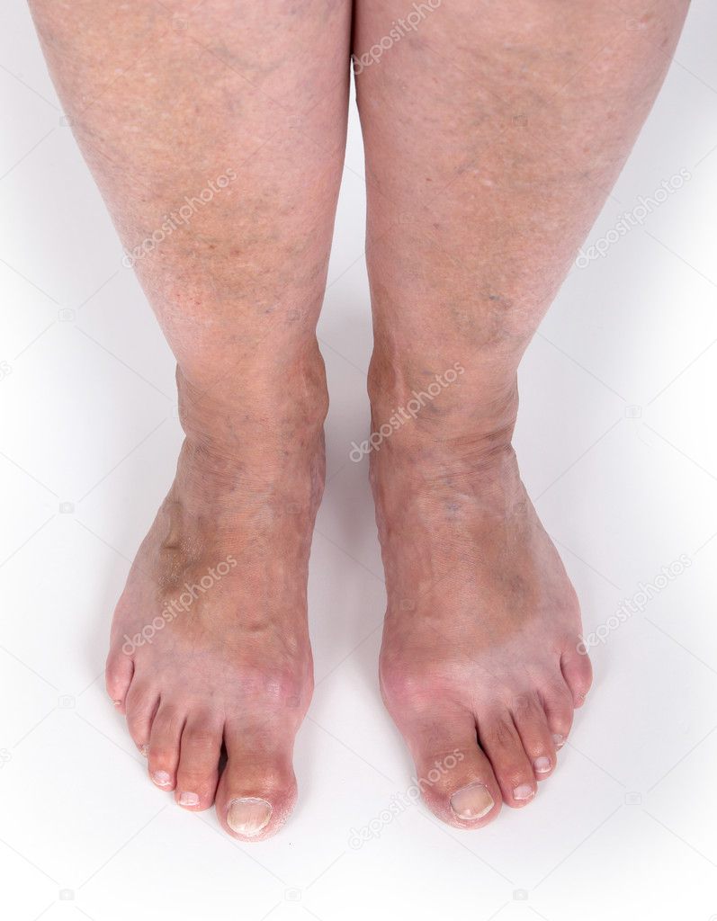 Old woman with varicose veins