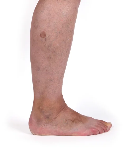 Old woman with varicose veins — Stock Photo, Image