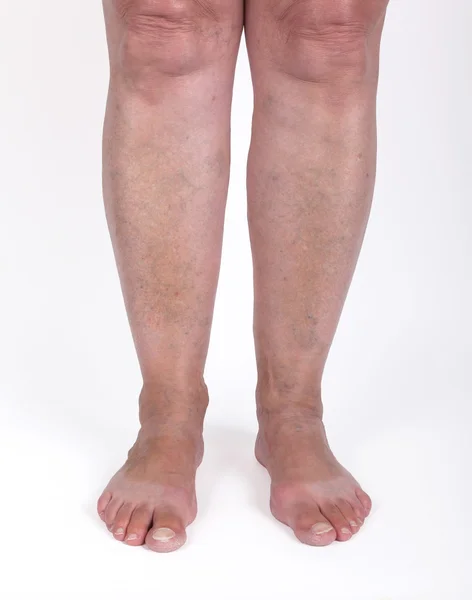 Old woman with varicose veins — Stock Photo, Image