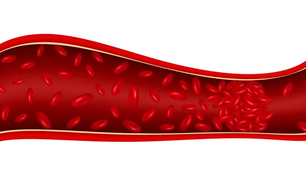 Caillot sanguin dans la veine. — Image vectorielle