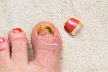Toe Tırnak büyüme yaralı
