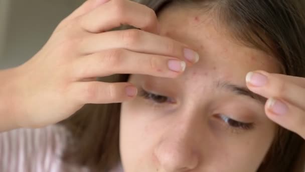 Zbliżenie, portret dziewczyna nastolatek wyciska pryszcze na jej twarz — Wideo stockowe