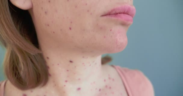 Närbild kvinna ansikte med blåmärken från kosmetiska injektioner — Stockvideo