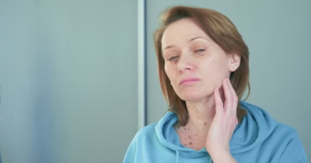 Портрет женщины с синяками от косметических инъекций — стоковое видео