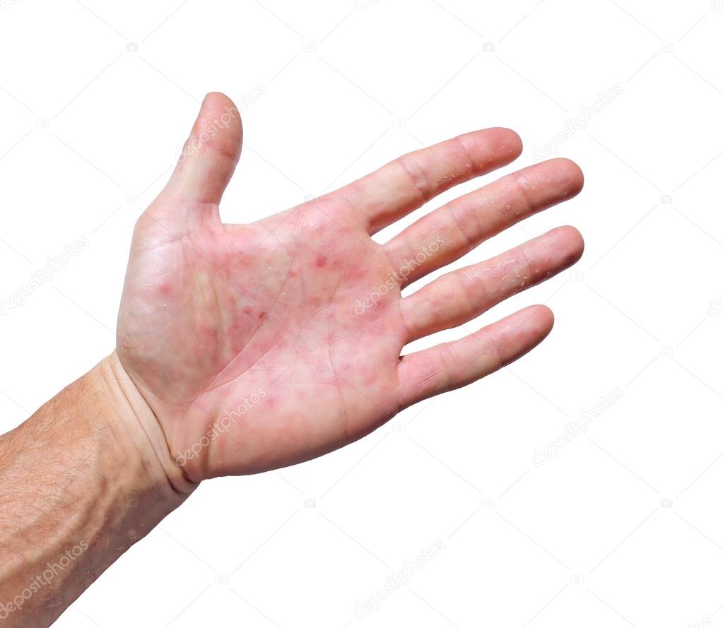 Palm patient erythema in red spots from inflammation Stock Photo by 89966852