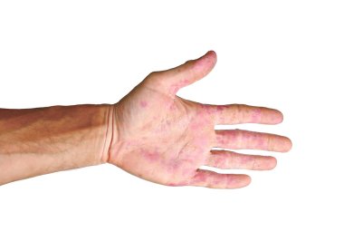 Palm patient erythema in red spots from inflammation isolated clipart