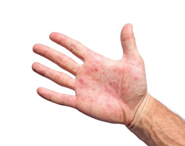 Palm hasta eritem inflamasyon ülser kırmızı izole
