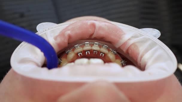 Oigenkännlig patient med tandställning — Stockvideo