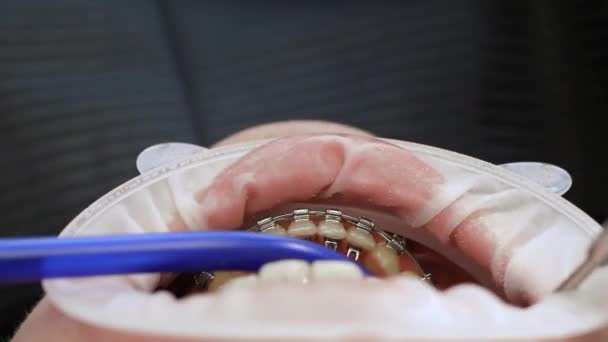 Unrecognizable patient with braces — Stock Video