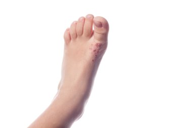 Egzama, Atopik dermatit. Egzama Deri çocuğun ayak üzerinde kapat