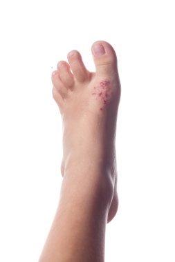 Egzama, Atopik dermatit. Egzama Deri çocuğun ayak üzerinde kapat