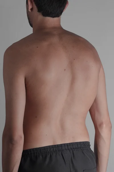 Сколиоз, худой мужчина на спине, без рубашки. кривизна спина — стоковое фото