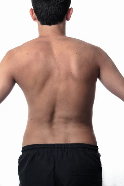Scoliose, dunne man op zijn rug, geen shirt. kromming van de spin — Stockfoto