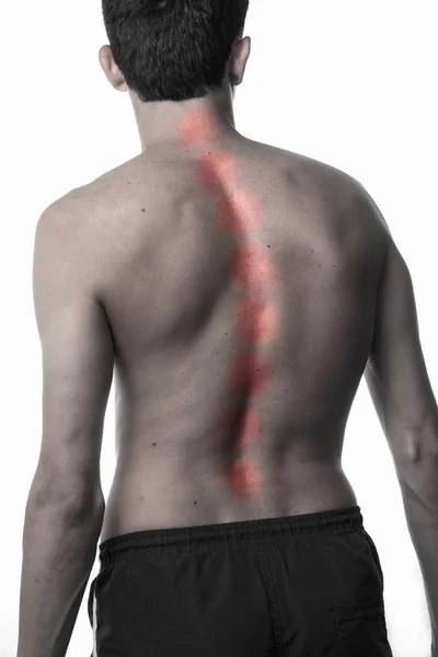 Scoliose, homme mince sur le dos, pas de chemise. courbure de la rotation — Photo