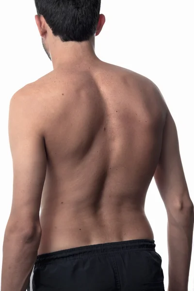 Сколиоз, худой мужчина на спине, без рубашки. кривизна спина — стоковое фото