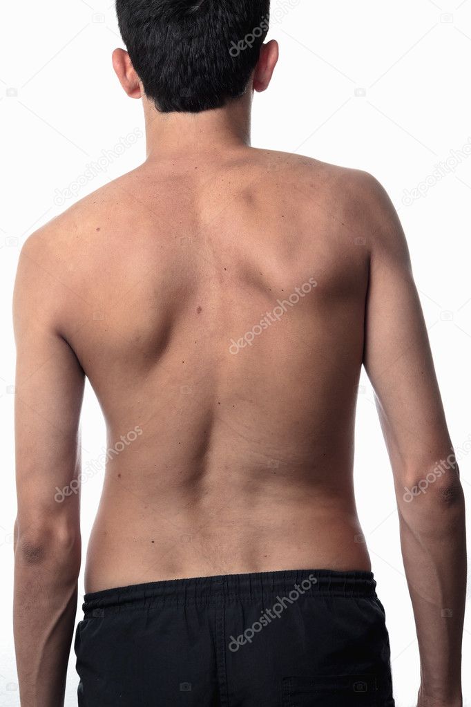 Scoliosis, thin man on his back, no shirt. curvature of the spin