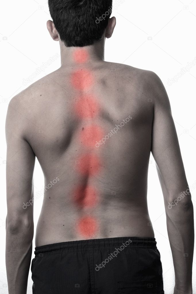 scoliosis, thin man on his back, no shirt. curvature of the spin