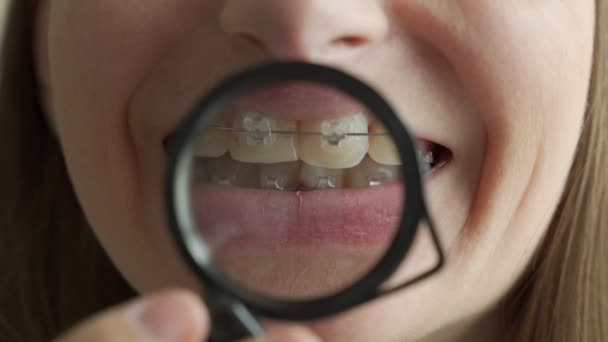 女人在放大镜中露出她的牙套 — 图库视频影像